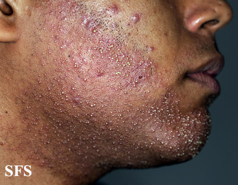 Acne caused by topical steroids