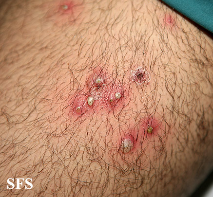 Staph Infection Pictures, Symptoms, Treatment & Contagious