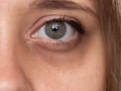 reduce eye puffiness, dark circles under eyes, natural eye treatments, home remedies for swollen eyes, eye bag solutions
