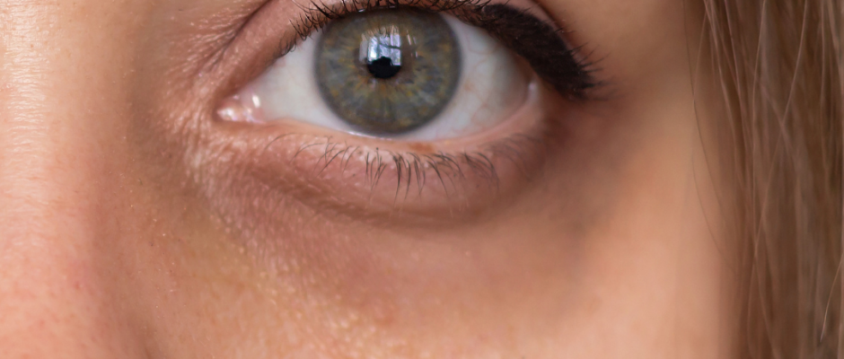 reduce eye puffiness, dark circles under eyes, natural eye treatments, home remedies for swollen eyes, eye bag solutions
