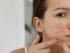 pimples vs acne, types of acne, severe acne symptoms, acne treatment options