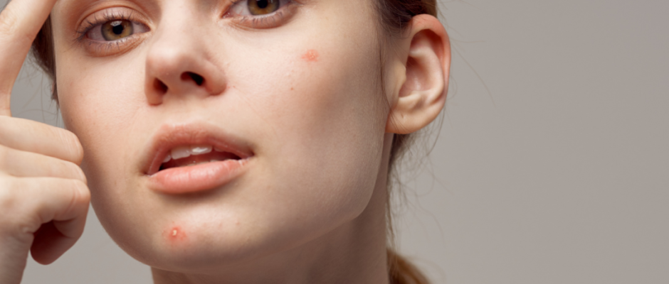 basic skincare for acne, daily routine to avoid pimples, natural acne prevention, skincare for oily skin, how to stop acne outbreaks, easy skin care regimen, pimple prevention habits, anti-acne daily routine, gentle cleansing for skin, moisturizing without clogging pores