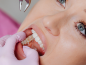 sugar and tooth decay, sugar cavities link, sugar dental damage