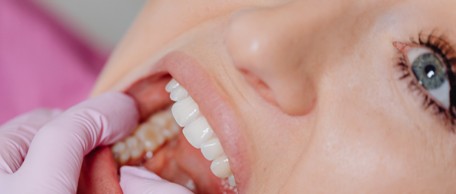sugar and tooth decay, sugar cavities link, sugar dental damage