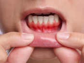 reverse gum disease, cure gum disease, heal gum disease