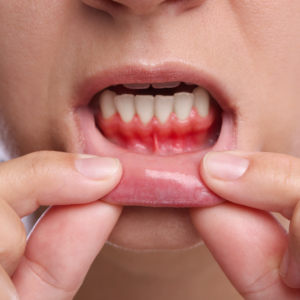 reverse gum disease, cure gum disease, heal gum disease