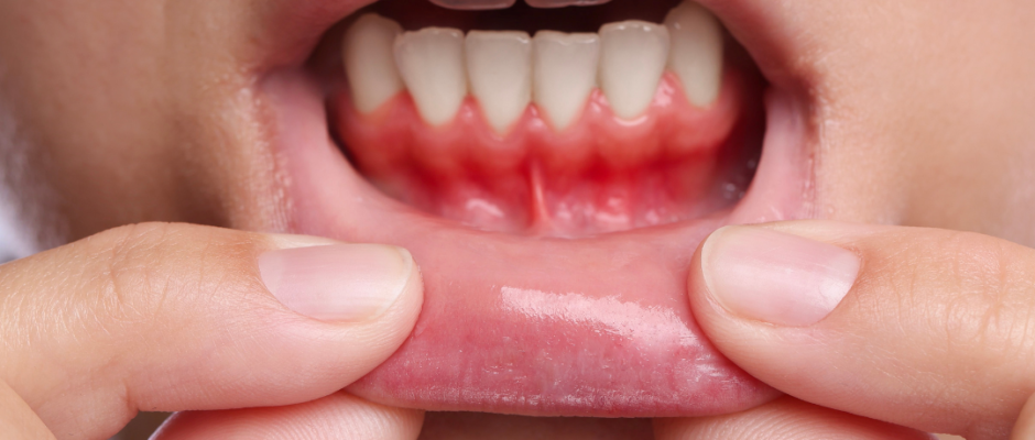 reverse gum disease, cure gum disease, heal gum disease