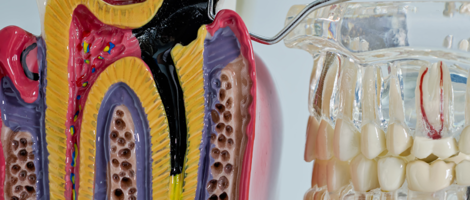 root canal treatment, infected tooth pain, root canal recovery, nerve pain tooth, tooth pulp infection, root canal anesthesia, severe toothache, dental nerve damage, root canal experience, root canal healing, root canal swelling