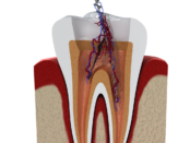 root canal cost, root canal price, cost of root canal, price of root canal treatment, dental root canal cost, root canal treatment cost, endodontic cost, tooth root canal price, average root canal cost, molar root canal cost