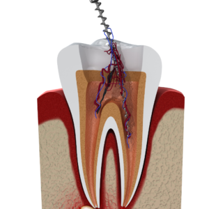 root canal cost, root canal price, cost of root canal, price of root canal treatment, dental root canal cost, root canal treatment cost, endodontic cost, tooth root canal price, average root canal cost, molar root canal cost