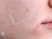 dry skin remedies, skin hydration, skin barrier repair, eczema winter care