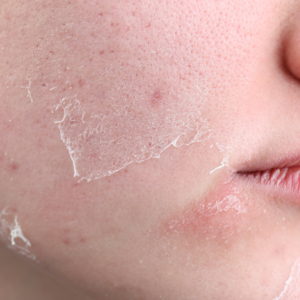 dry skin remedies, skin hydration, skin barrier repair, eczema winter care