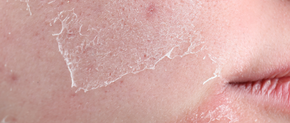 dry skin remedies, skin hydration, skin barrier repair, eczema winter care