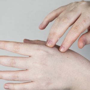 cold fingers, cold toes, winter circulation problems, numb hands, tingling feet, nerve issues, temperature sensitivity, cold body, vascular health