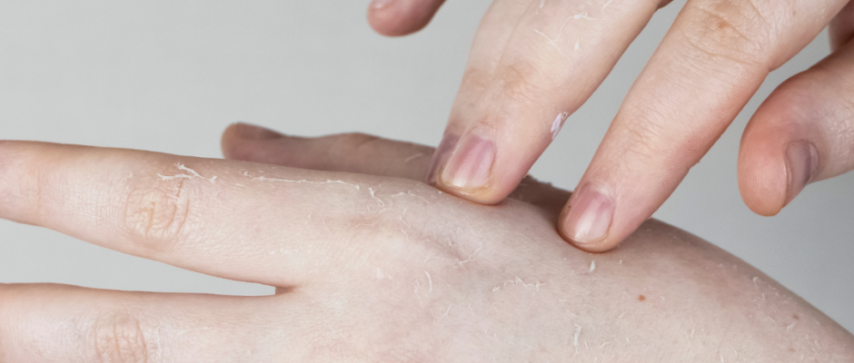 cold fingers, cold toes, winter circulation problems, numb hands, tingling feet, nerve issues, temperature sensitivity, cold body, vascular health