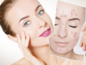 Acne treatments, Clear skin solutions, Pimple cures, Blemish remedies, Natural acne solutions