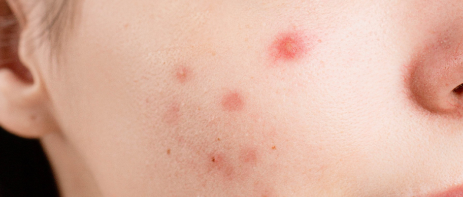 Makeup acne link, cosmetics clog pores, makeup breakouts, acne from makeup, prevent makeup acne, clogged pores makeup