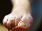 Stop fungal nail infections, avoid nail fungus, fungal nail prevention, protect nails from fungus, prevent toenail fungus, nail fungus prevention tips