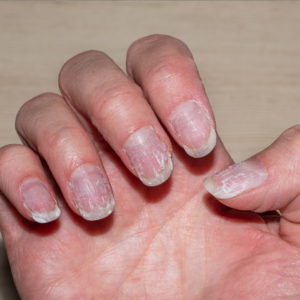 Nail health issues, problems, unhealthy nail symptoms, signs, nail abnormalities, poor nail condition, nail care
