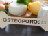 Osteoporosis risk factors, bone health, bone density test, prevent osteoporosis, fragility fractures, bone strength, calcium deficiency, vitamin D for bones