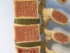 Bone density, osteoporosis causes, osteoporosis prevention, young adult bone health, early osteoporosis symptoms.