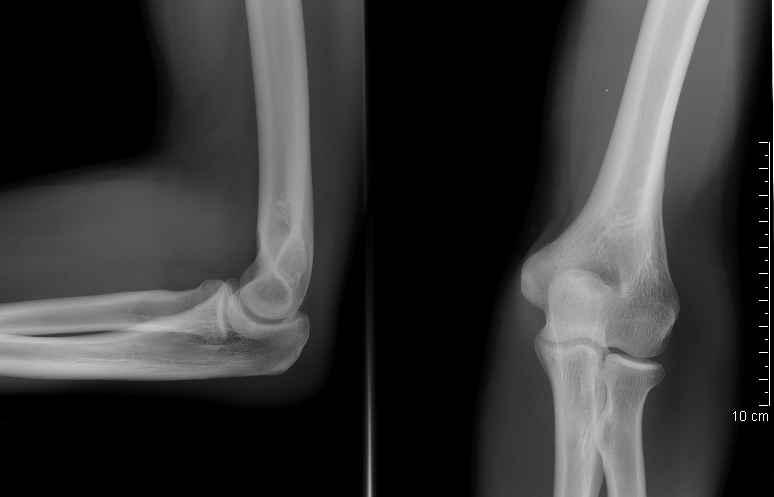 Sore Elbow due to Injuries like Fracture and Dislocation | Healthhype.com