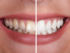 natural teeth whitening, home remedies white teeth, professional whitening options, foods whiten teeth, teeth whitening risks, whitening myths debunked