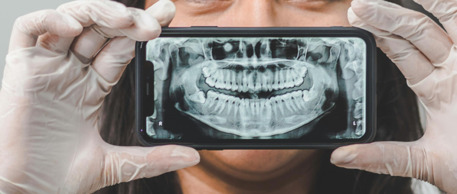 dental x-rays, benefits of dental x-rays, types of dental x-rays, dental x-ray safety