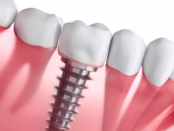 missing teeth solutions, implant dentistry benefits, oral health restoration, permanent tooth replacement, dental implant candidates, bone grafting for implants, dental implant costs, alternatives to dental implants