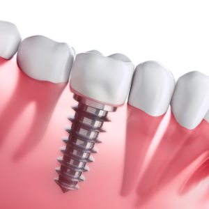 missing teeth solutions, implant dentistry benefits, oral health restoration, permanent tooth replacement, dental implant candidates, bone grafting for implants, dental implant costs, alternatives to dental implants