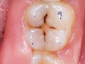 oral hygiene tips, fluoride toothpaste benefits, dental floss techniques, healthy diet for teeth, regular dental checkups, children dental care, adult oral health, gum disease prevention, enamel protection methods