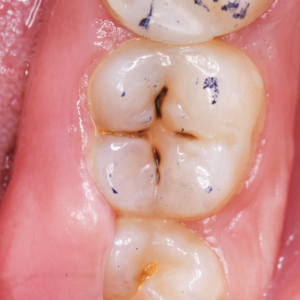 oral hygiene tips, fluoride toothpaste benefits, dental floss techniques, healthy diet for teeth, regular dental checkups, children dental care, adult oral health, gum disease prevention, enamel protection methods