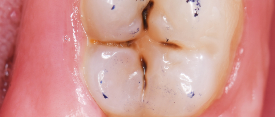 oral hygiene tips, fluoride toothpaste benefits, dental floss techniques, healthy diet for teeth, regular dental checkups, children dental care, adult oral health, gum disease prevention, enamel protection methods