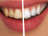 treat yellow teeth, stained teeth treatment, teeth whitening methods, yellow teeth remedies