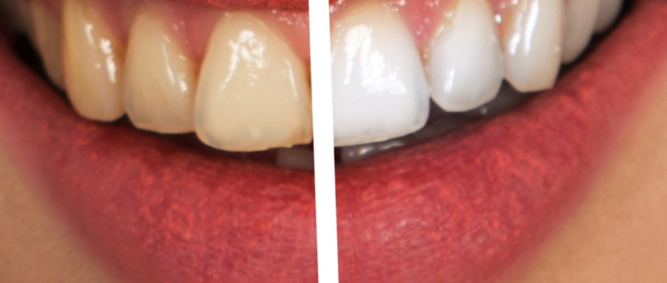 treat yellow teeth, stained teeth treatment, teeth whitening methods, yellow teeth remedies