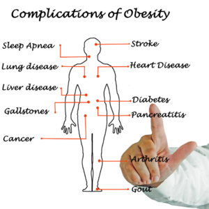 obesity causes, childhood obesity, genetic factors in obesity, environmental influences on obesity, obesity prevention strategies, obesity health risks, breaking obesity cycle