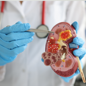 kidney stone prevention, kidney stone symptoms, kidney stone treatment, dehydration and stones, kidney-friendly diet, urinary health, kidney stone risk factors, calcium oxalate stones