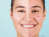 Natural acne treatments, acne home remedies, clear skin tips, acne prevention, hormonal acne causes, diet and acne, acne skin care, natural remedies for acne, acne scar treatment, stress and acne, oily skin acne, acne fighting foods, herbal acne remedies, acne natural cures, acne skincare routine, natural acne solutions