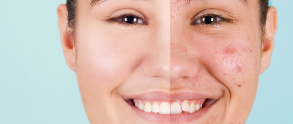Natural acne treatments, acne home remedies, clear skin tips, acne prevention, hormonal acne causes, diet and acne, acne skin care, natural remedies for acne, acne scar treatment, stress and acne, oily skin acne, acne fighting foods, herbal acne remedies, acne natural cures, acne skincare routine, natural acne solutions