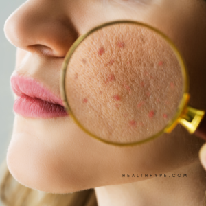 Acne prevention, natural skincare, skin care routine, healthy skin diet, acne treatment, natural remedies, skin hydration, stress acne, oily skin care, anti-aging skin tips, DIY face masks, skin cleansing tips, hormonal acne treatments, skin detox methods, natural acne treatments, skin health supplements, face mask benefits, acne scar treatment, environmental skin care, skin pH balance, mental health and acne