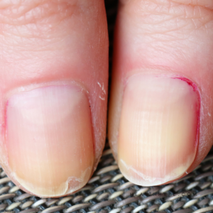 Nail problems, brittle nails, nail discoloration, nail ridges, fungal nail infection, nail growth, nail strength, cuticle care, nail hygiene, nail diet, nail supplements, nail abnormalities, nail splitting, nail peeling, nail health signs, nail care routine, natural nail remedies, nail health vitamins, nail health symptoms, nail health for women
