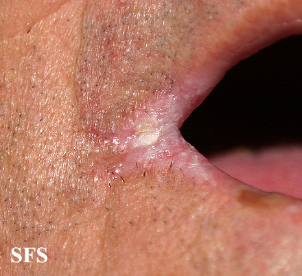Cracking Corner of Mouth and Lips Causes and Remedies - Healthhype