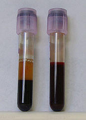 Melena (Dark Blood) and Hematochezia (Fresh Blood) in Stool - Healthhype