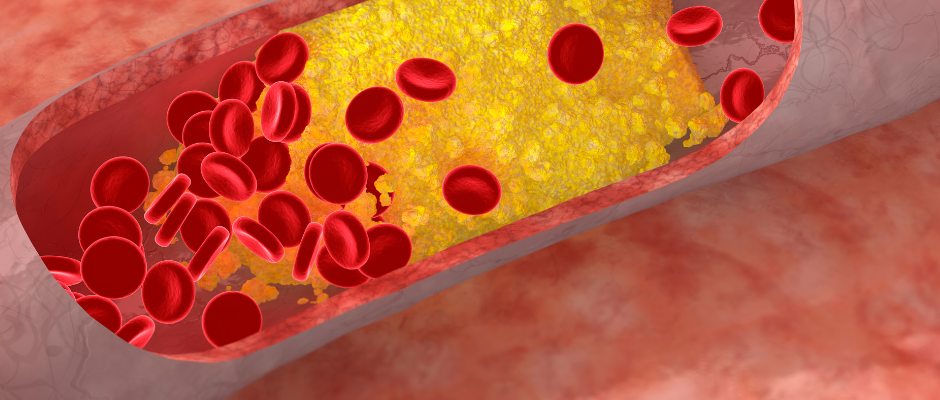 Illustration depicting common symptoms of high cholesterol such as fatigue, breathlessness, and potential dizziness