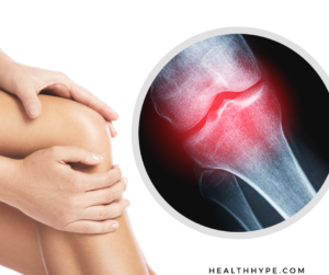 Illustration of knee pain showing joint inflammation and cartilage wear