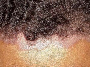 alison scalp healthhype rashes psoriasis