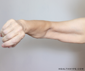 A close-up of a woman’s arm, showing reduced muscle definition and potential muscle loss.