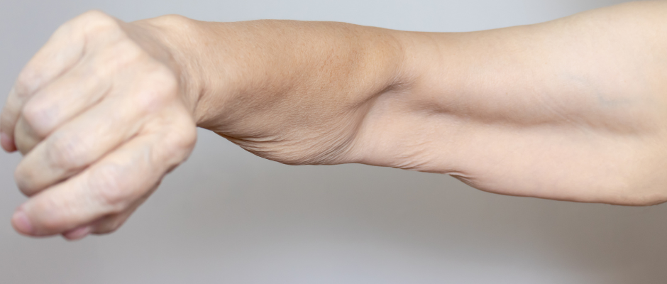 A close-up of a woman’s arm, showing reduced muscle definition and potential muscle loss.
